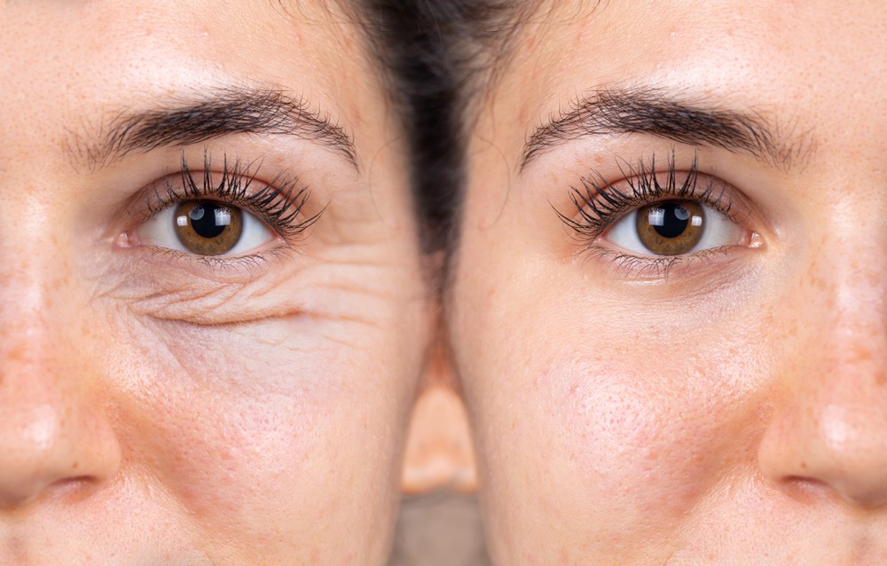 blaferoplastia barcelona