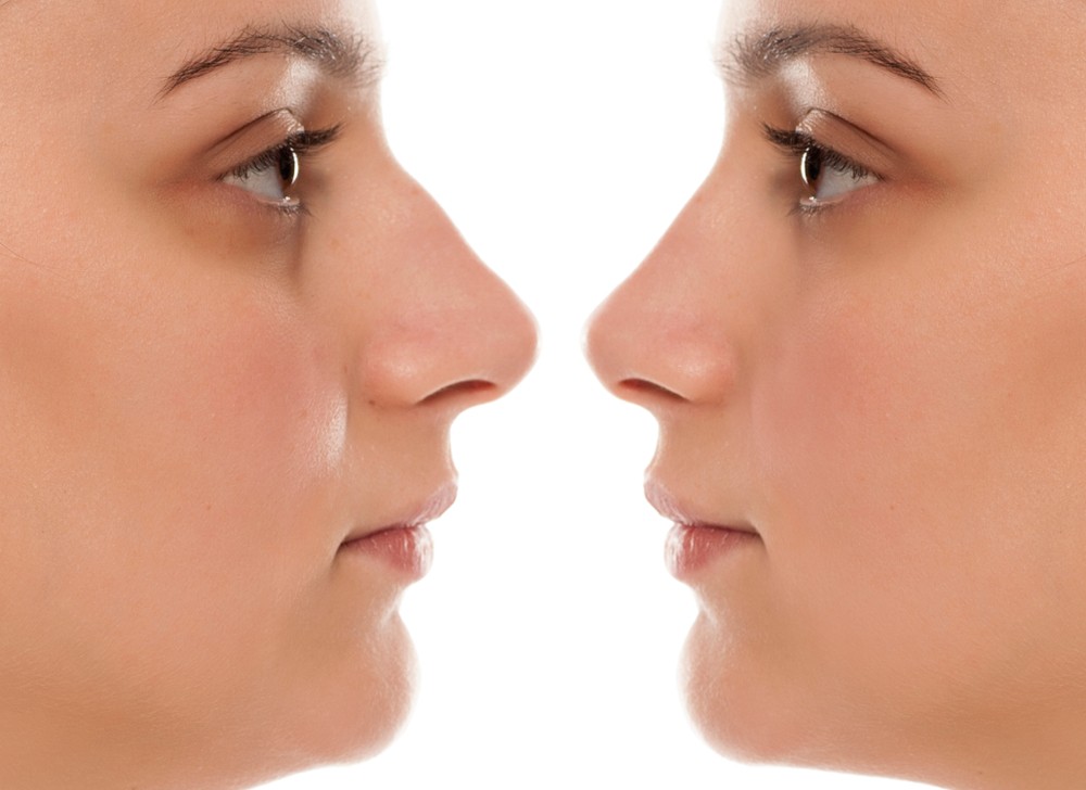 rinoplastia barcelona