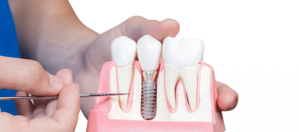 osteointegración de implantes