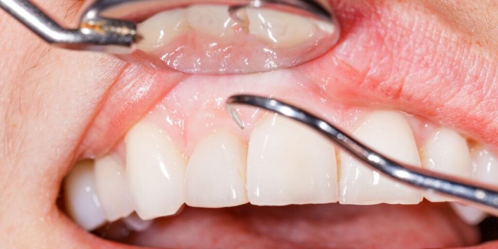 bolsas periodontales