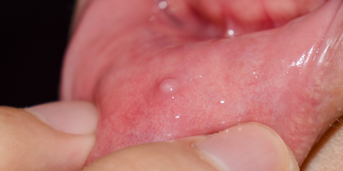 Mucocele ¿En qué consiste?