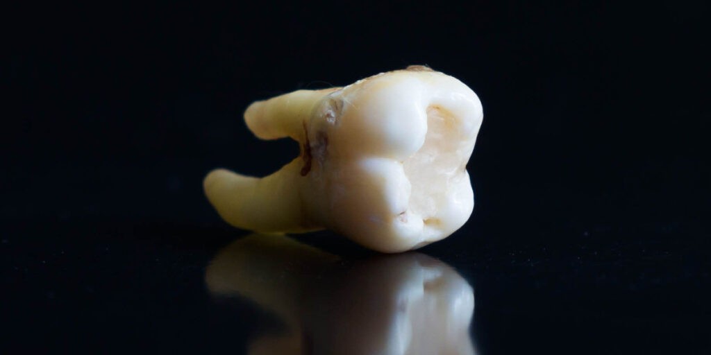 caries radiculares