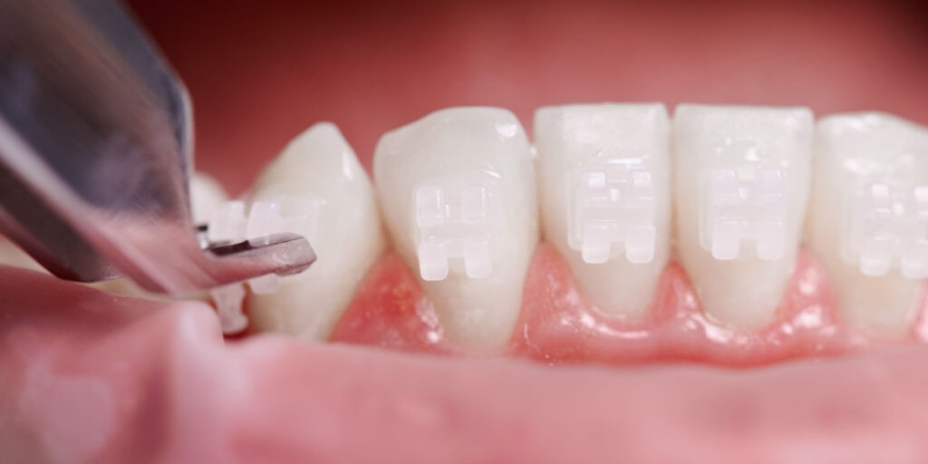 atacs invisalign