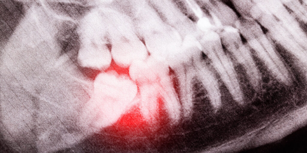 pericoronitis