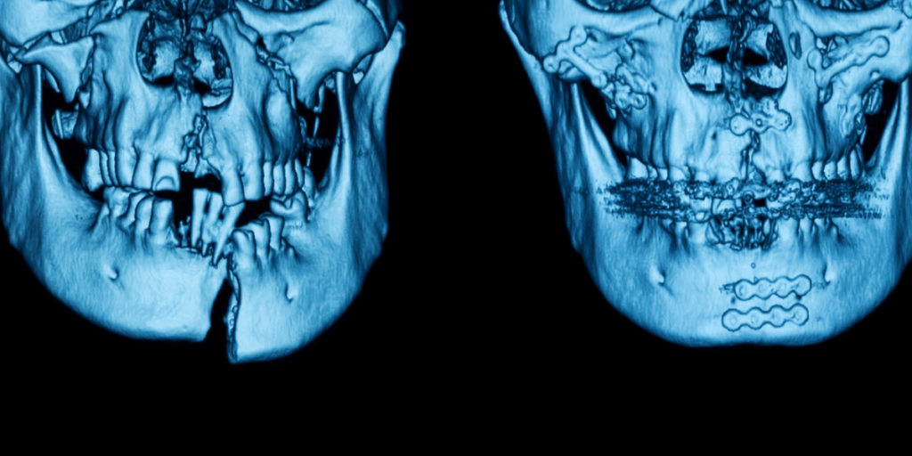 fractura mandibular