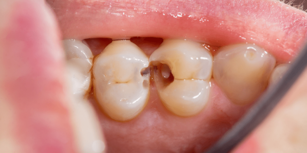 tipos de caries