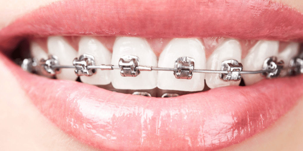 brackets autolligats