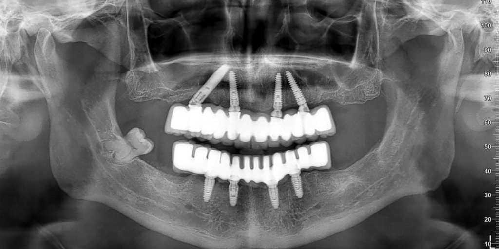 implantes cigomáticos