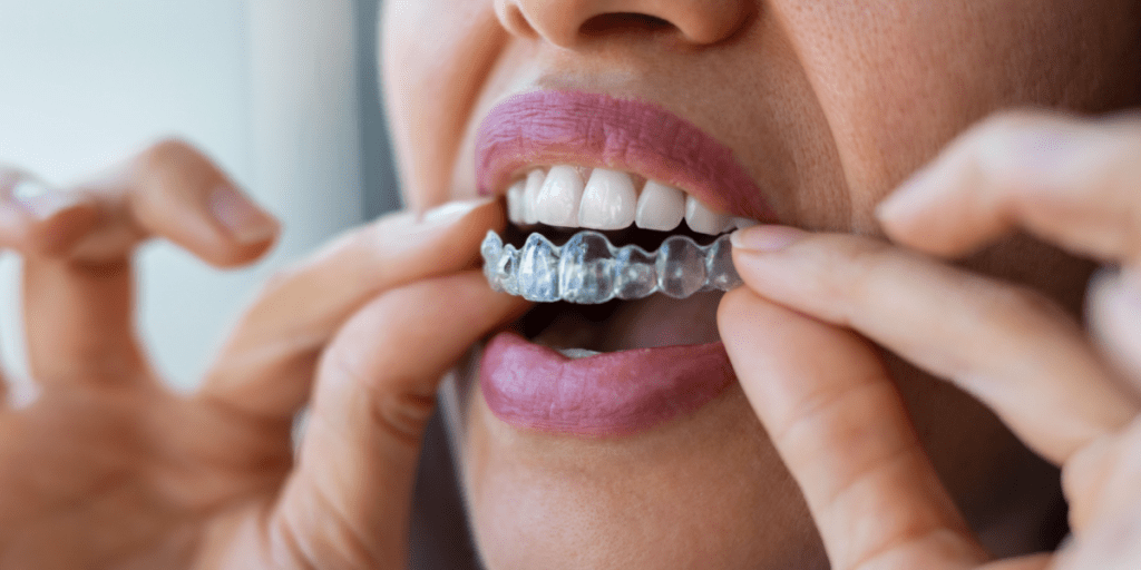 Com es mouen les dents amb l'ortodòncia invisible?