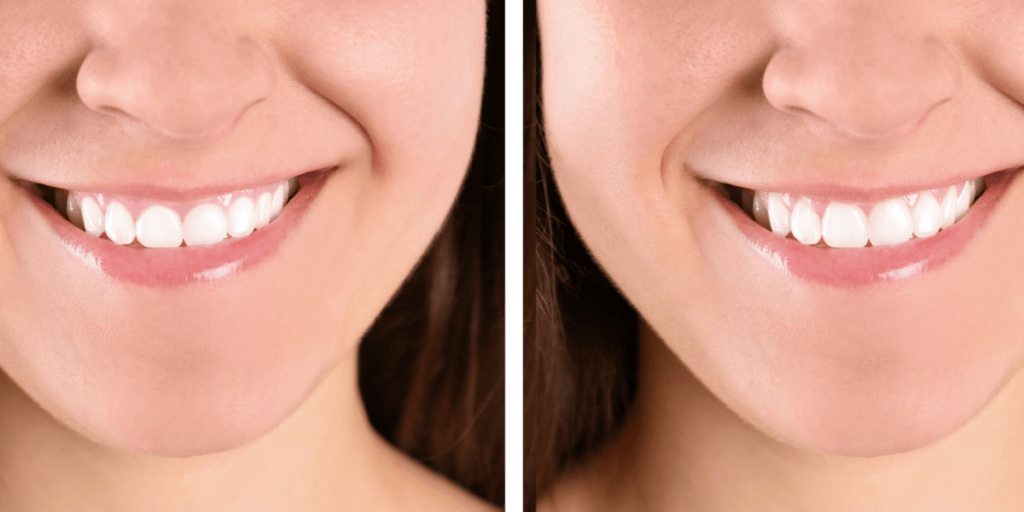gingivoplastia