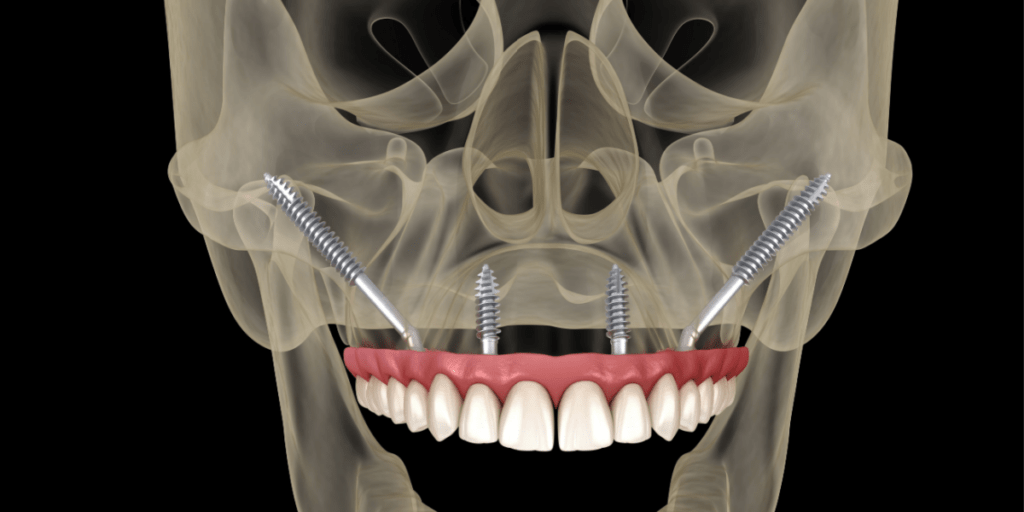 implants corticals