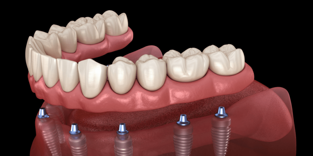 pròtesi sobre implants