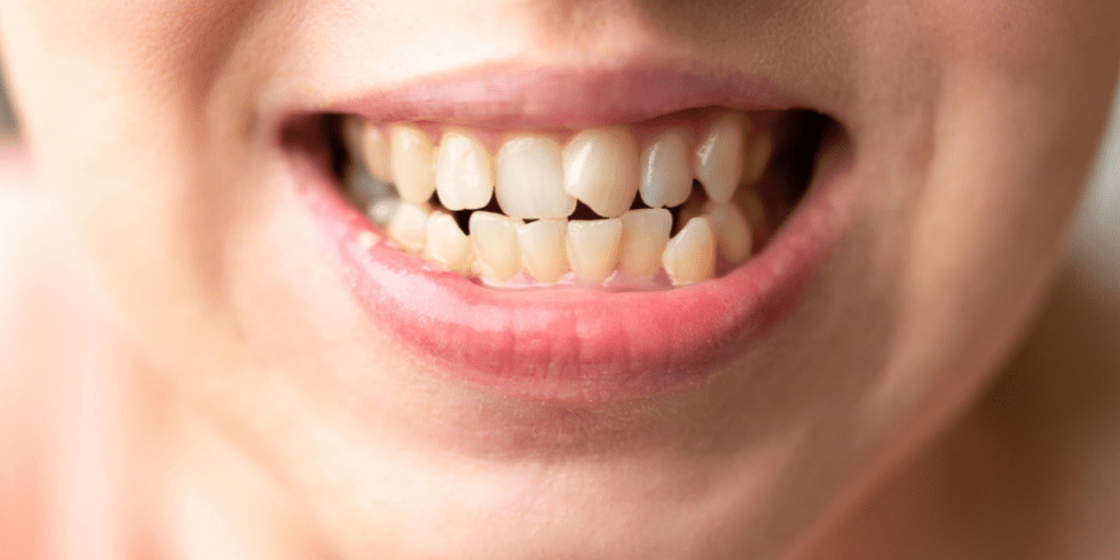 dientes torcidos