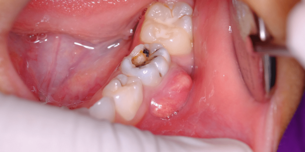 fístula dental