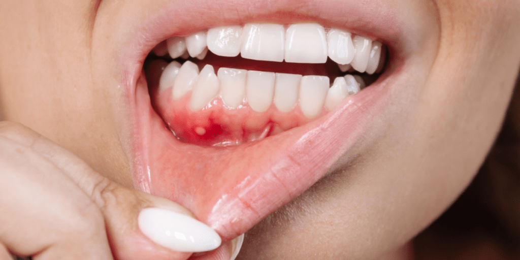 gingivoestomatitis