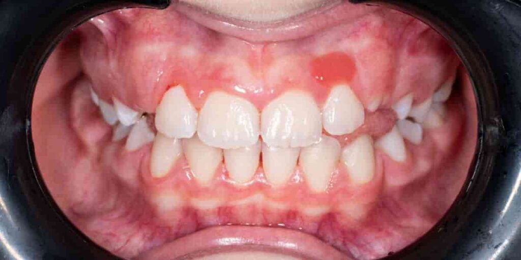 hemangioma