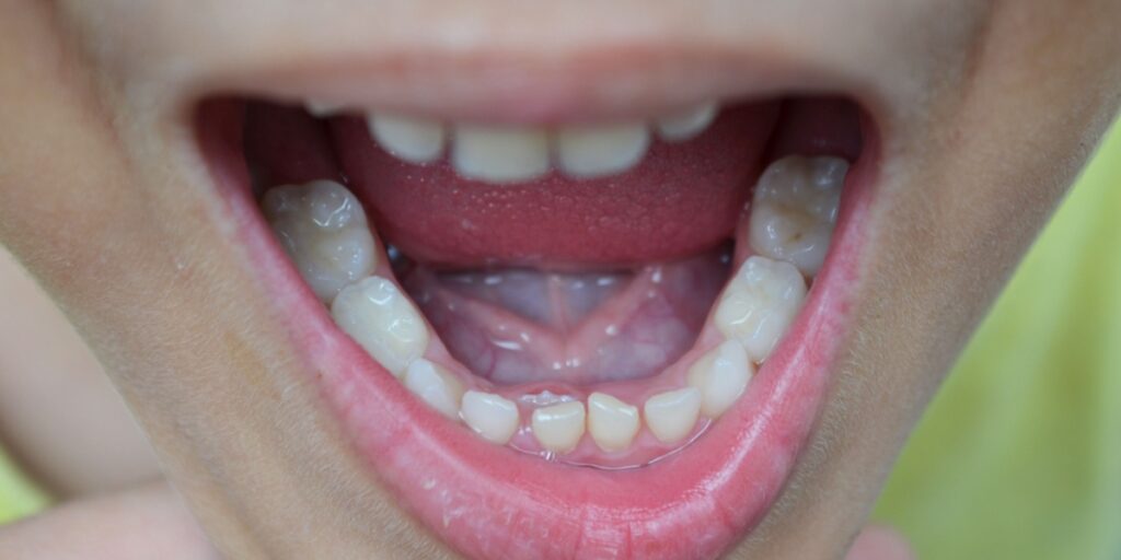 anquiloglosia