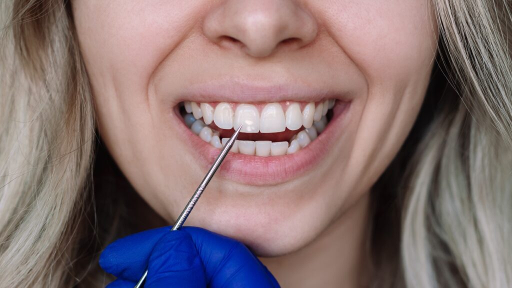 discromía dental