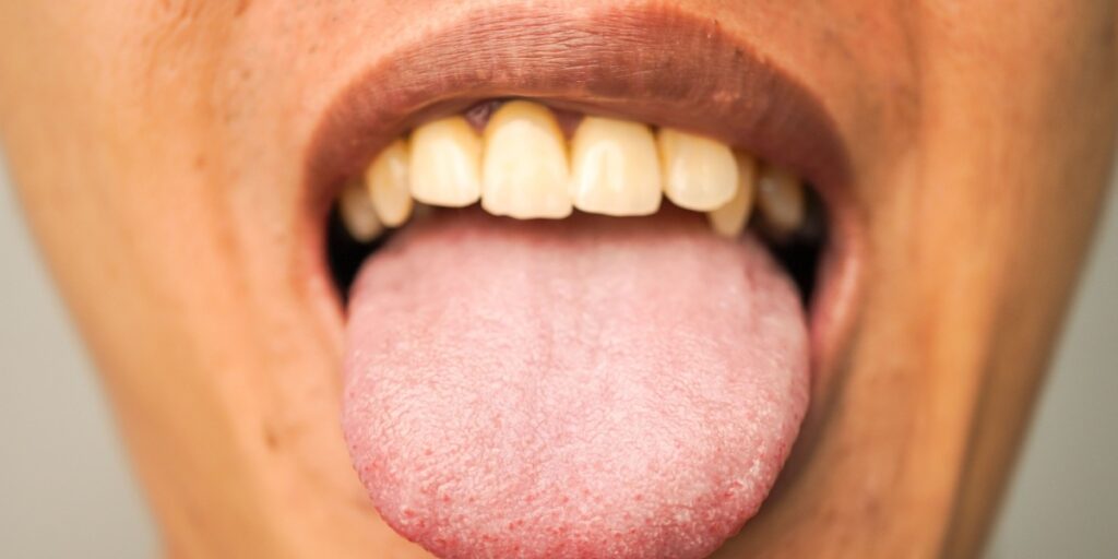 macroglosia