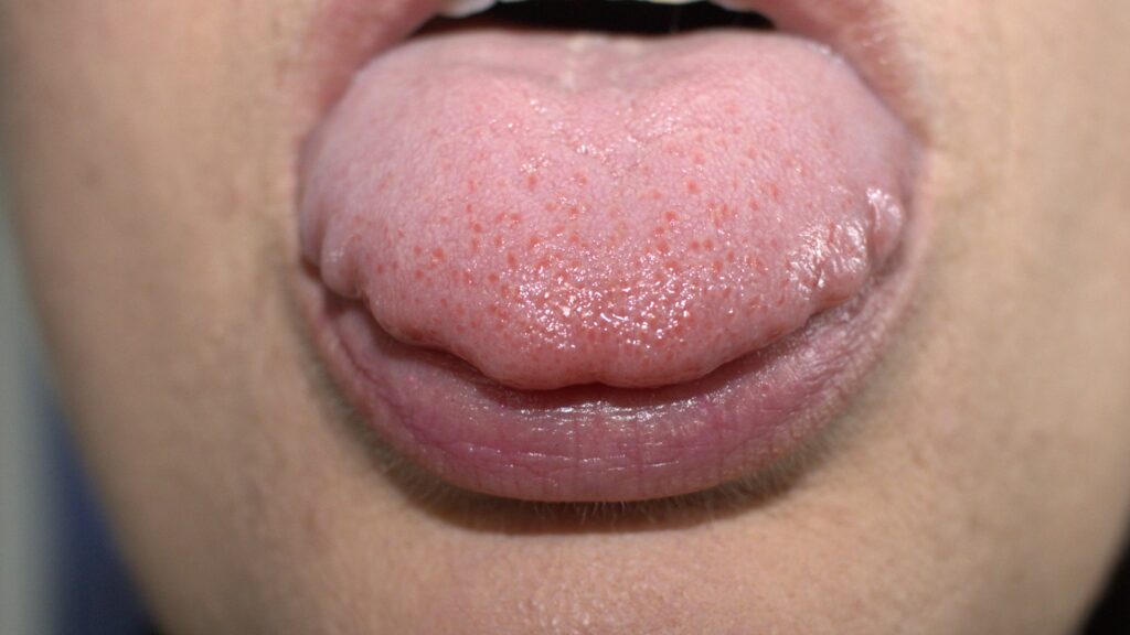 papilitis lingual