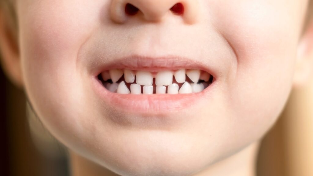 dientes conoides