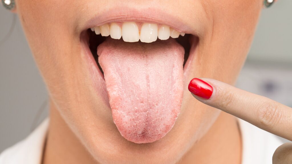 candidiasis oral
