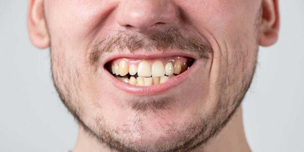 sonrisa torcida