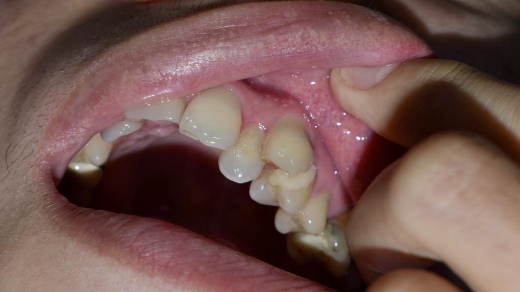 diente en infraversión