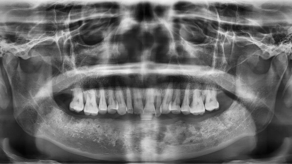 necrosis ósea maxilar