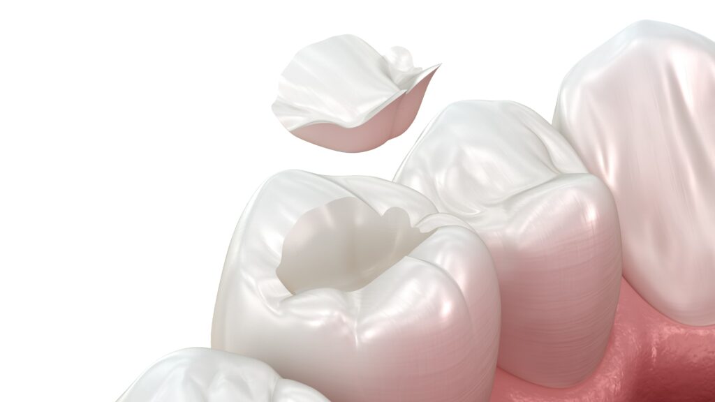 reconstrucción dental