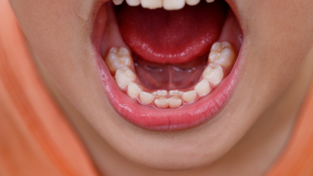 dientes de tiburón en niños