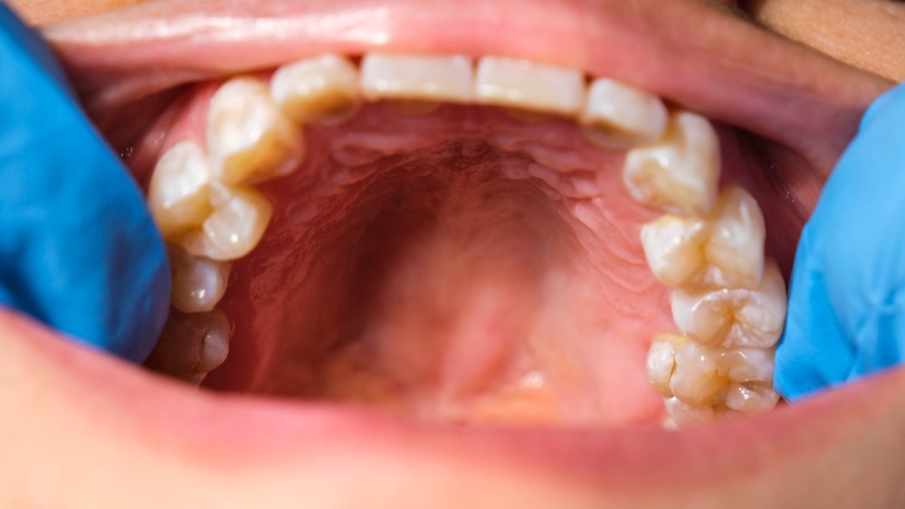 sensación de presión en el paladar