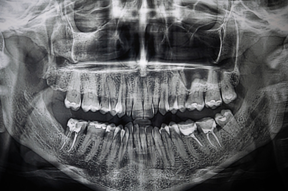 granuloma periapical