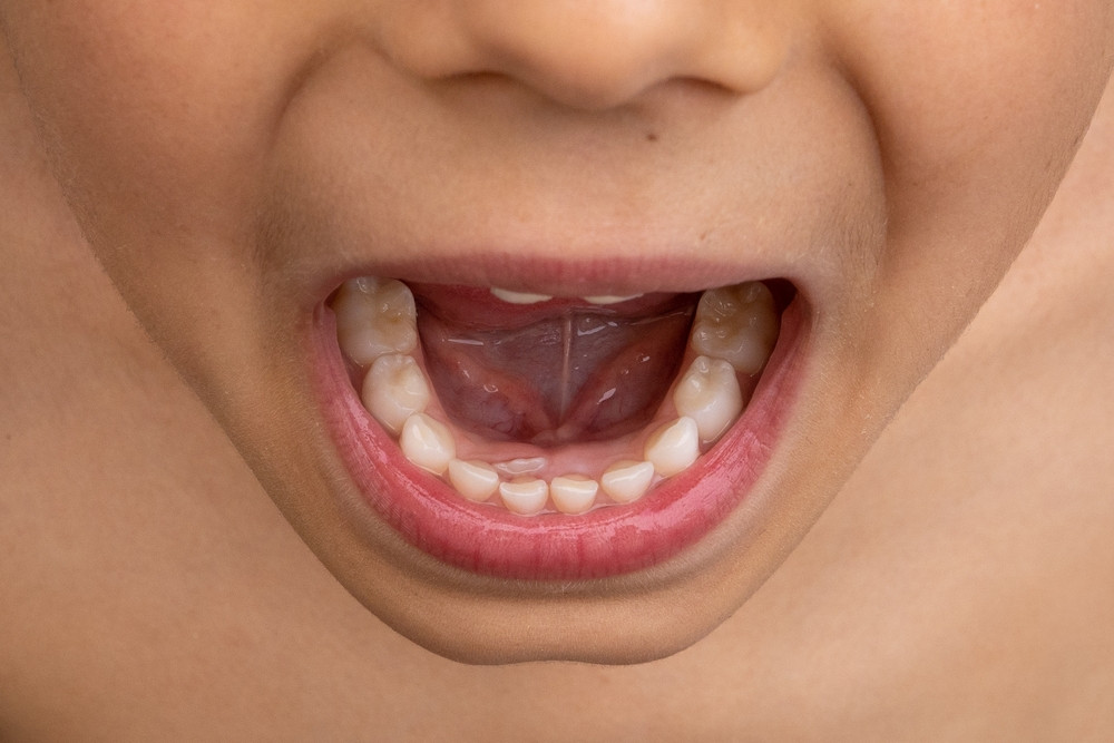 dientes supernumerarios