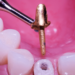 perno dental